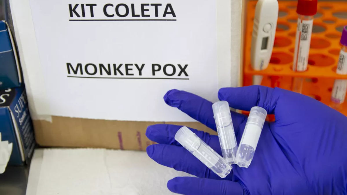 casos suspeitos varíola macacos