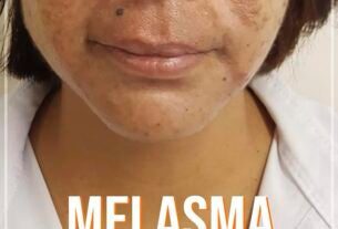 Melasma pode ser tratado com ativos específicos