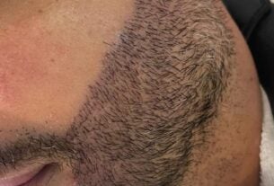 Transplante de barba cresce no mercado masculino