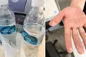 Garrafa de água mineral Mineratta ao lado da mão do paciente com sinais de queimadura