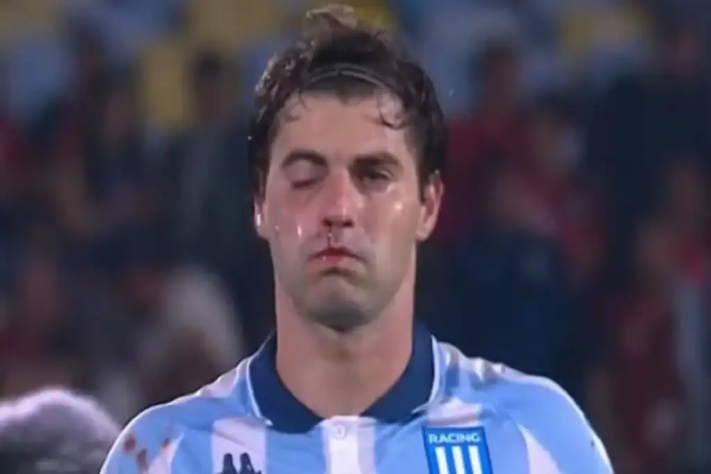 Imagem de Santiago Sosa, zagueiro do Racing, com o olho roxo e rosto inchado após cotovelada