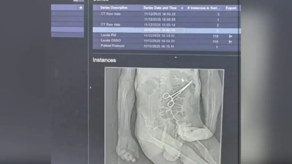 Raio-X mostrando pinça cirúrgica esquecida no corpo de paciente